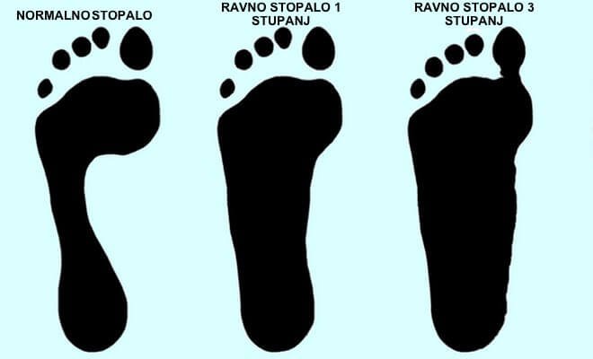 Ravno stopalo